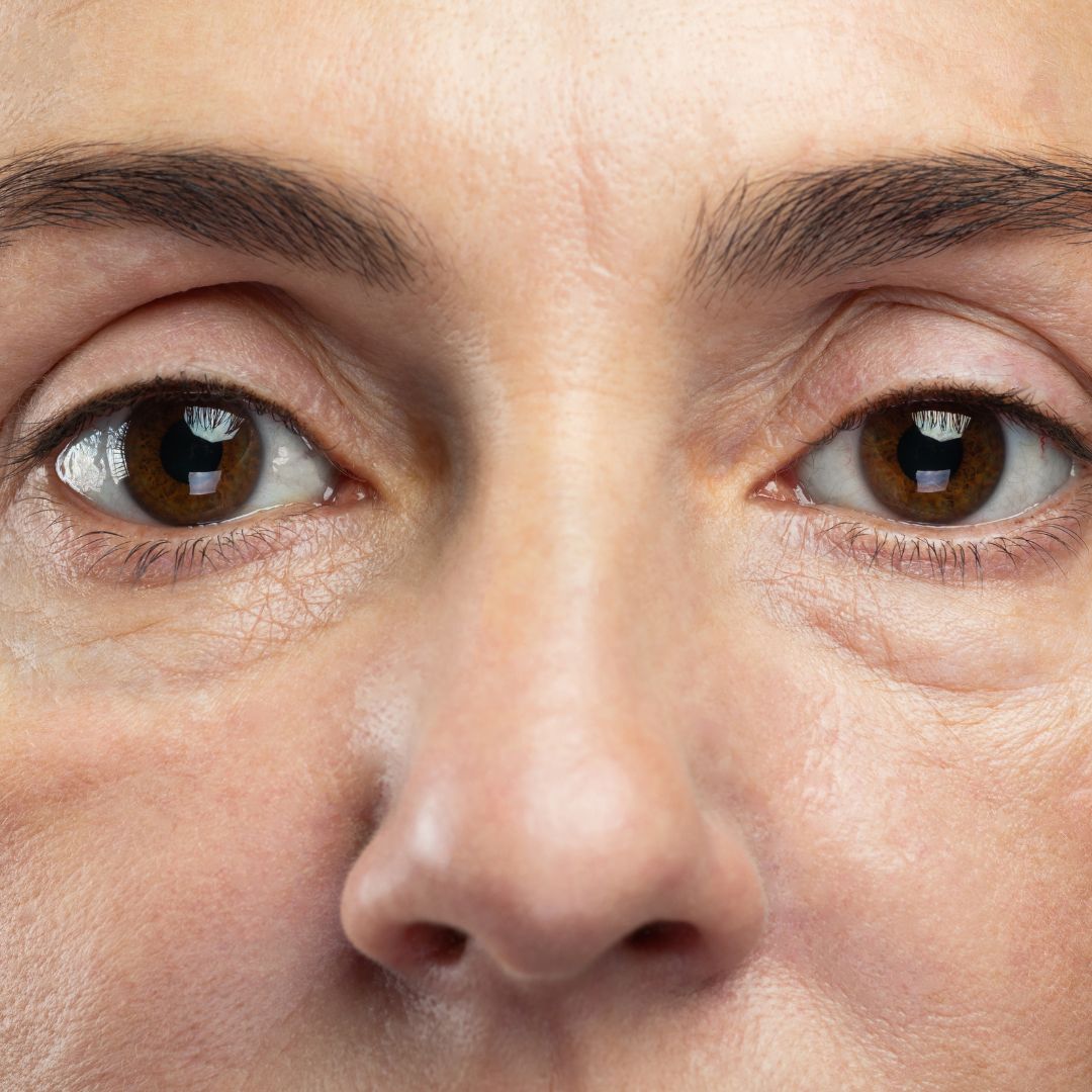 ultherapy under eye treatment in nashville tn